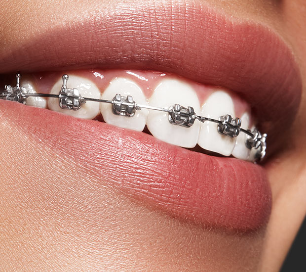 Traditional Braces - Lovrovich Orthodontics Seattle, WA Orthodontist