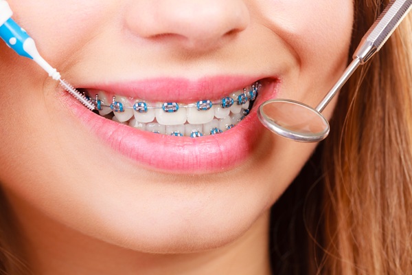 Dental Braces: Types And Applications