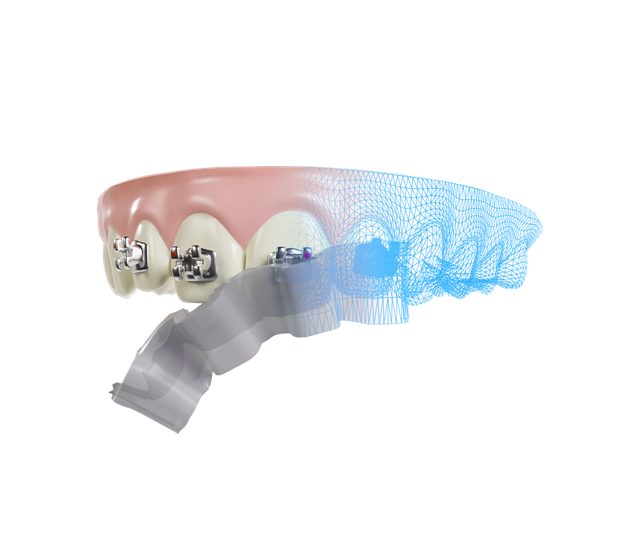 Seattle Find the Best Orthodontist