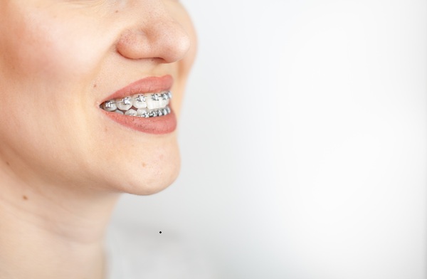 Reasons To Choose Traditional Metal Braces